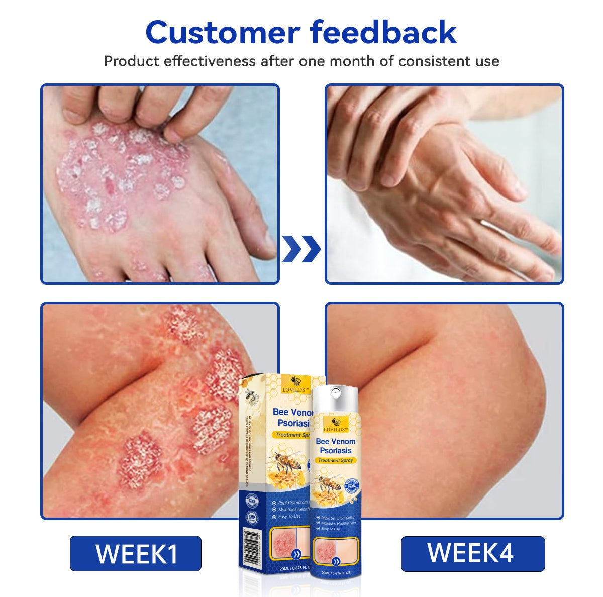 LOVILDS™ PsoriaHeal Bee Venom Psoriasis Treatment Spray pro